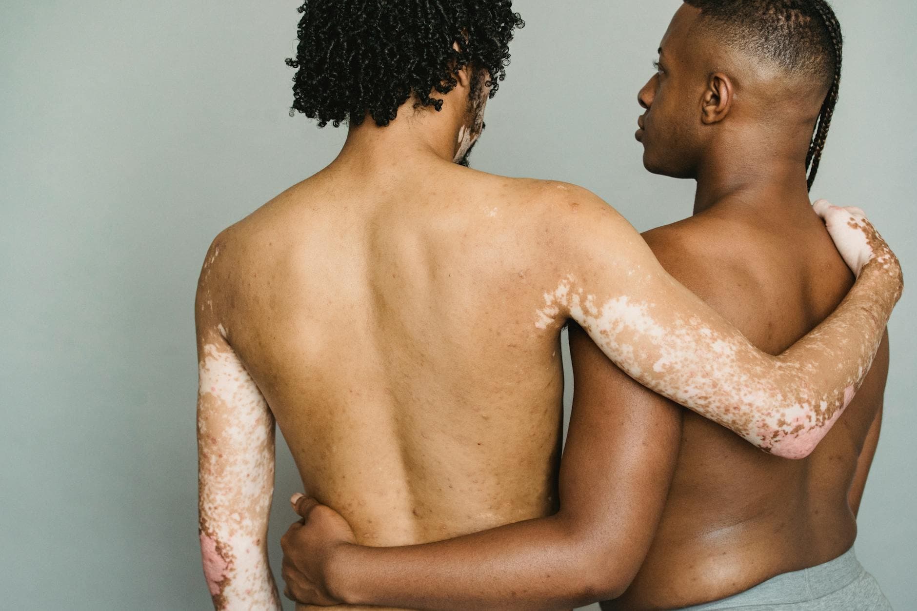 Two men embracing, one with depigmentation, symbolizing love and diversity. - self compassion outdoors