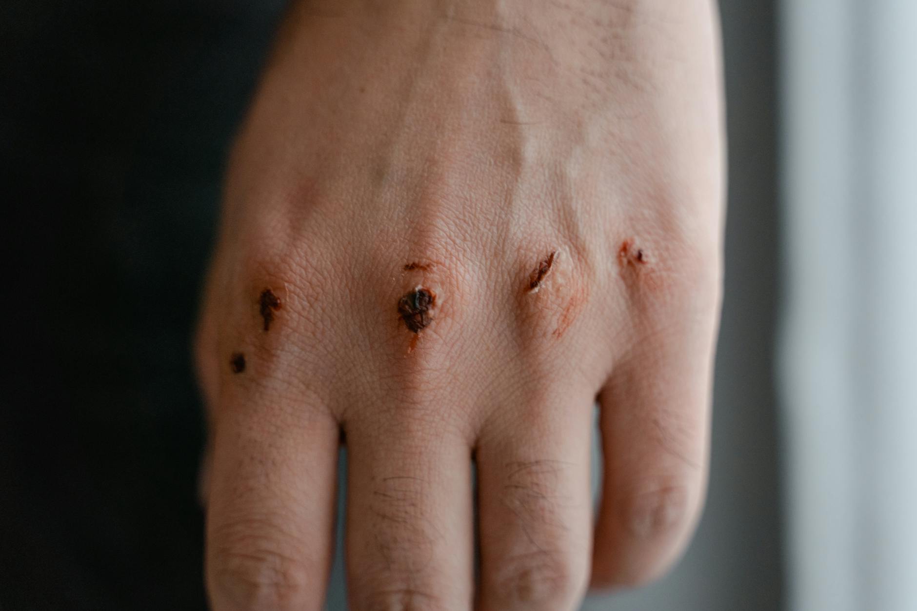 Close-up view of a hand showing scars and injuries on the knuckles. - peter levine trauma healing