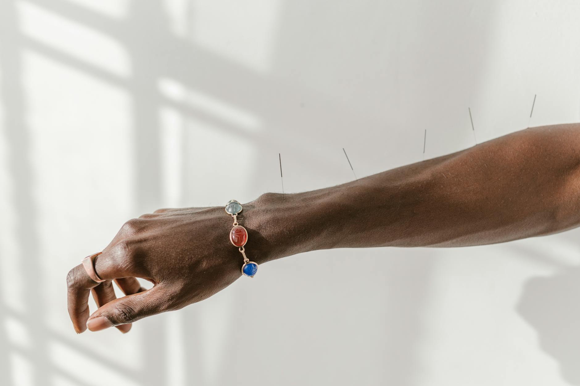 A close-up shot of a hand wearing a gemstone bracelet with acupuncture needles on the arm. - therapy integration skills
